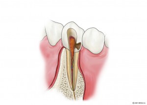抜髄1　初診時 ◎